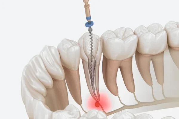 Root Canal & Restorative