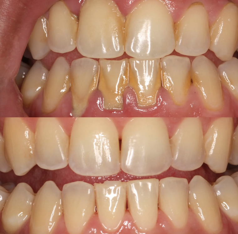 WHY DENTAL SCALING MATTERS FOR YOUR SMILE
