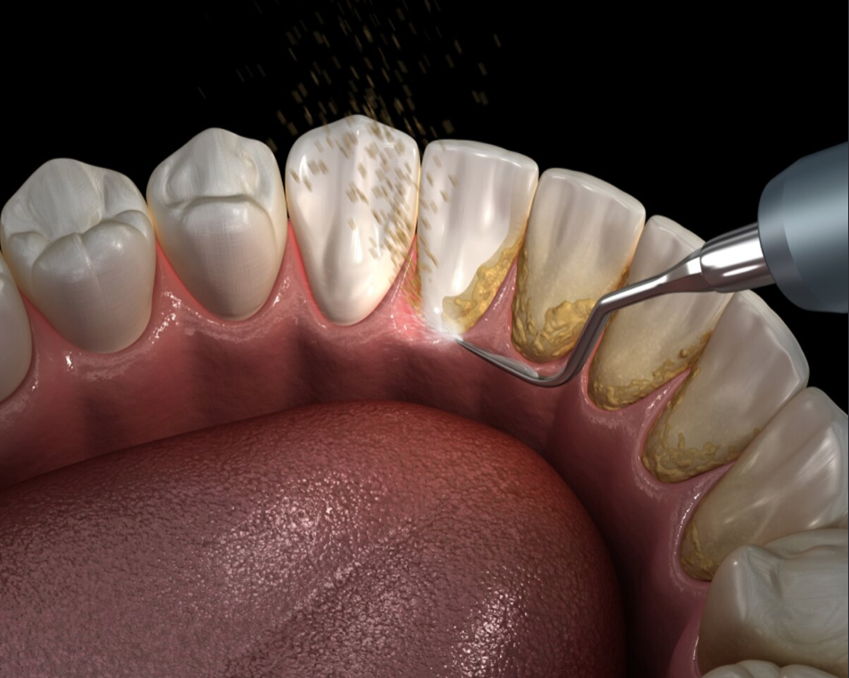TEETH CLEANING & SCALING