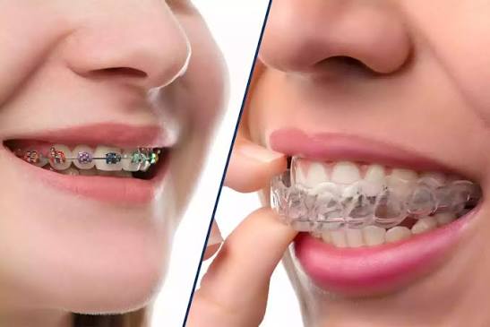 ORTHODONTICS (BRACES & ALIGNERS)